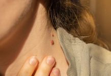 Best Home Remedies to Remove Skin Tags Fast